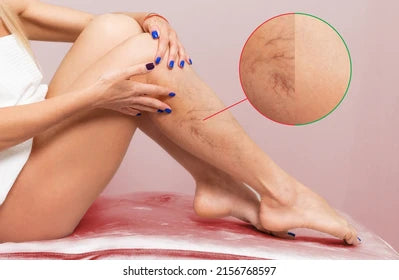 PARCHE PARA PIERNAS VARICES